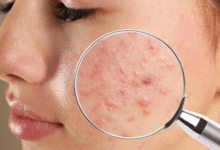 products for acne-prone skin