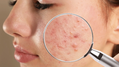 products for acne-prone skin