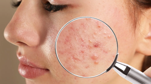 products for acne-prone skin